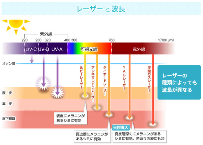 シミ取り治療のレーザー治療と光治療の違いは何 特徴や効果をわかりやすく一覧表で比較掲載