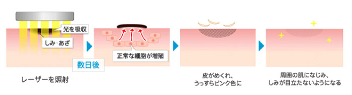 レーザー照射の流れ