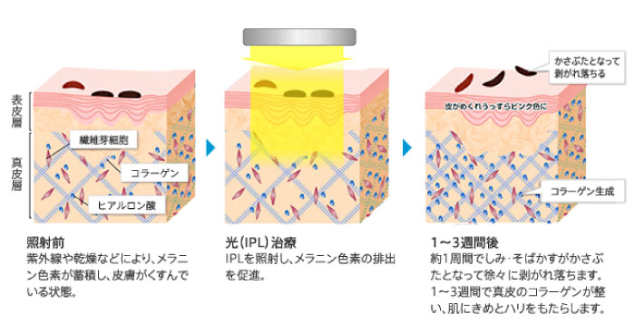 光治療のイメージ画像