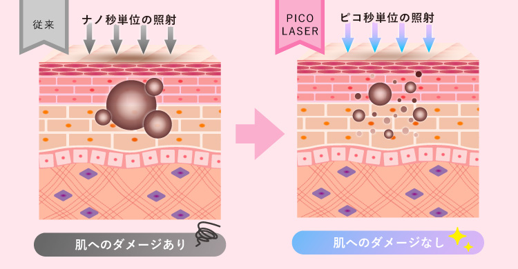 ピコレーザーの仕組みイメージ画像