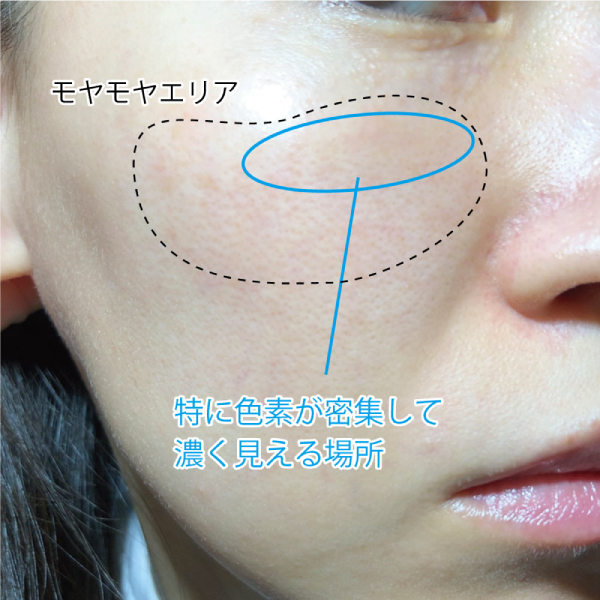 肝斑が気になるエリア（右頬）