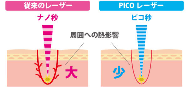 PICOレーザー照射時の肌へのダメージ比較