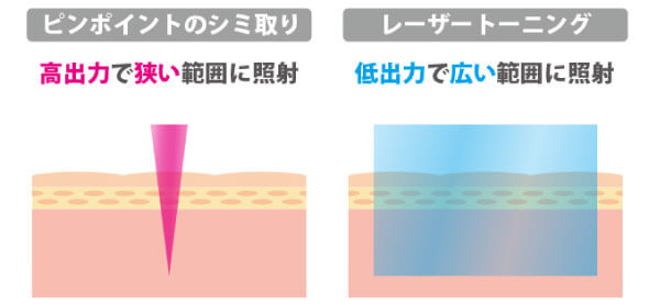 シミ取りレーザー・トーニングの照射範囲