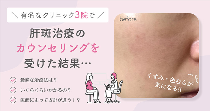 有名なクリニック3院で肝斑治療のカウンセリングを受けた結果