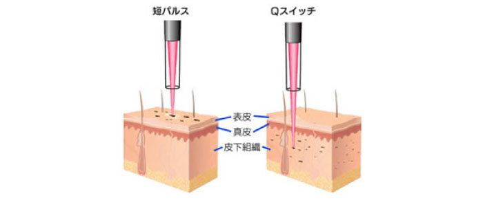 Qスイッチモードと短パルスモード